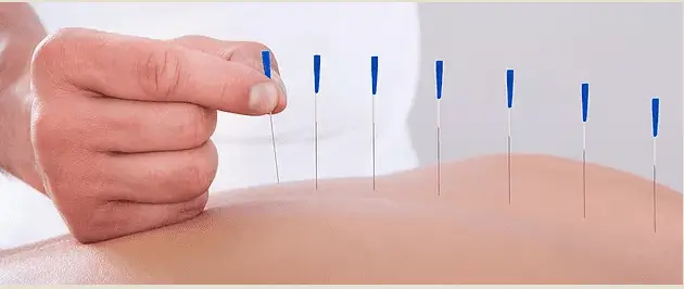 dry needling asheville nc