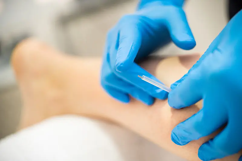 dry needling Asheville physical therapy
